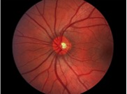 Test Your Macular Degeneration Risk